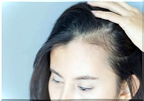 Female alopecia and psychological repercussions